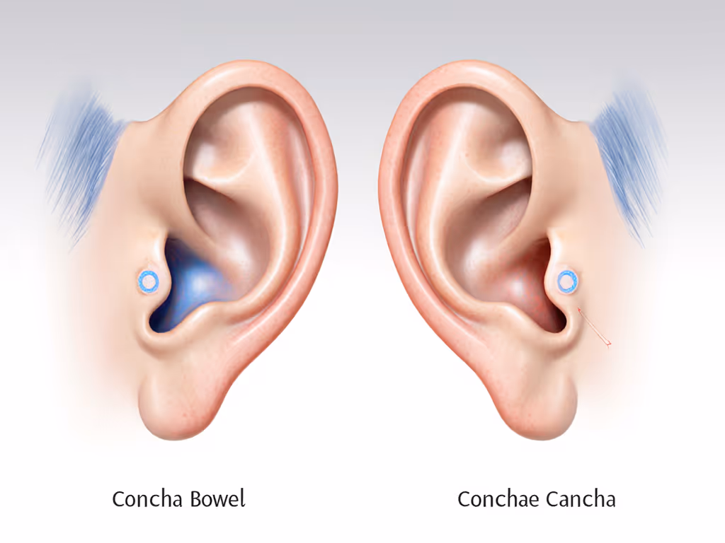 side-by-side_ear_anatomy_diagram_showing_tragus_concha_and_canal_variations